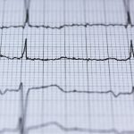 electrocardiograma